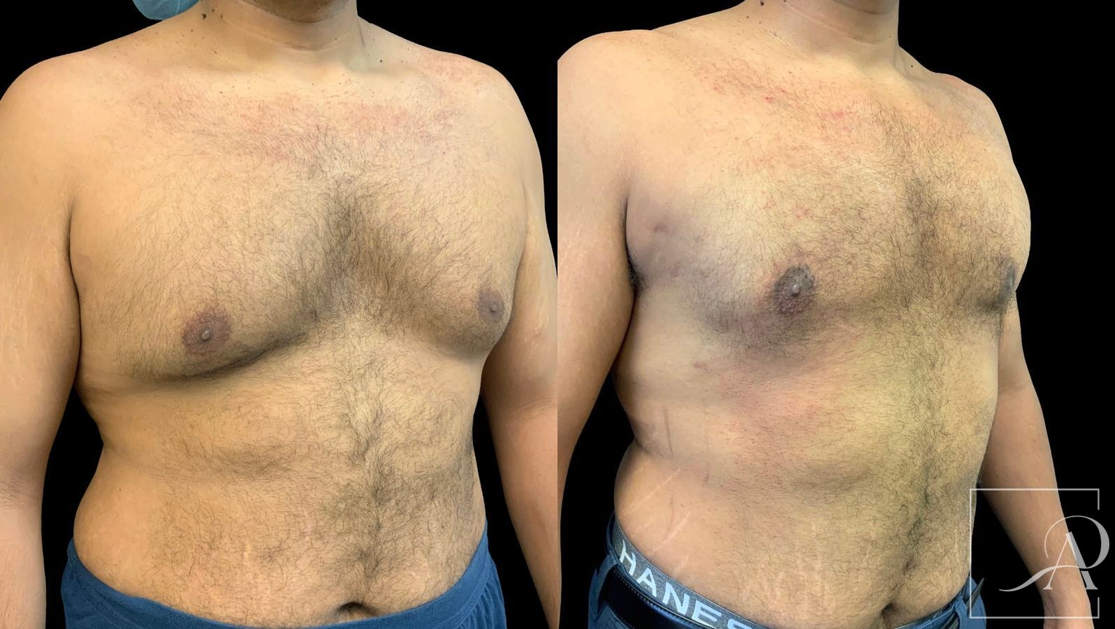 Before and after Gynecomastia case 43367 - Angle 4