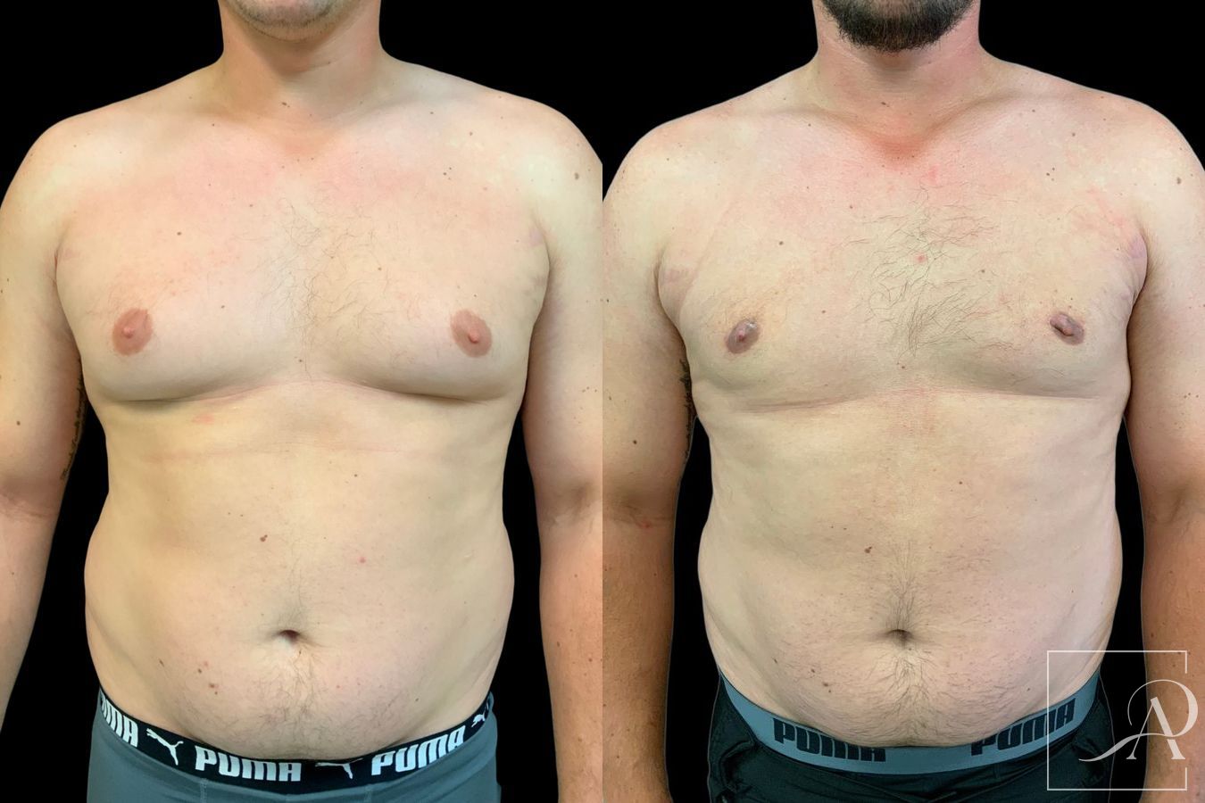 Before and after Gynecomastia case 46132