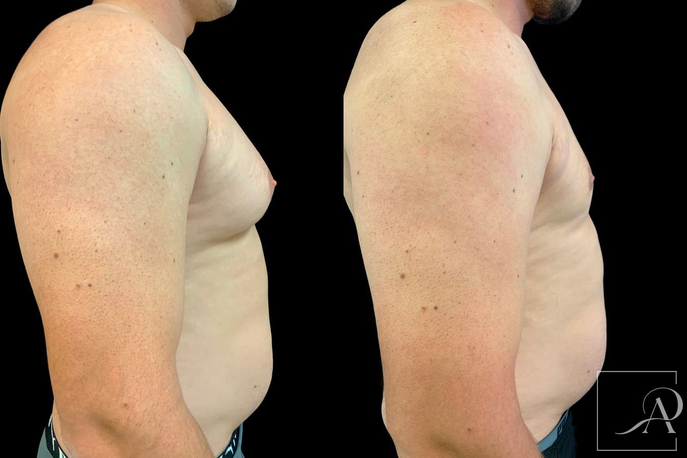 Before and after Gynecomastia case 46132 - Angle 5