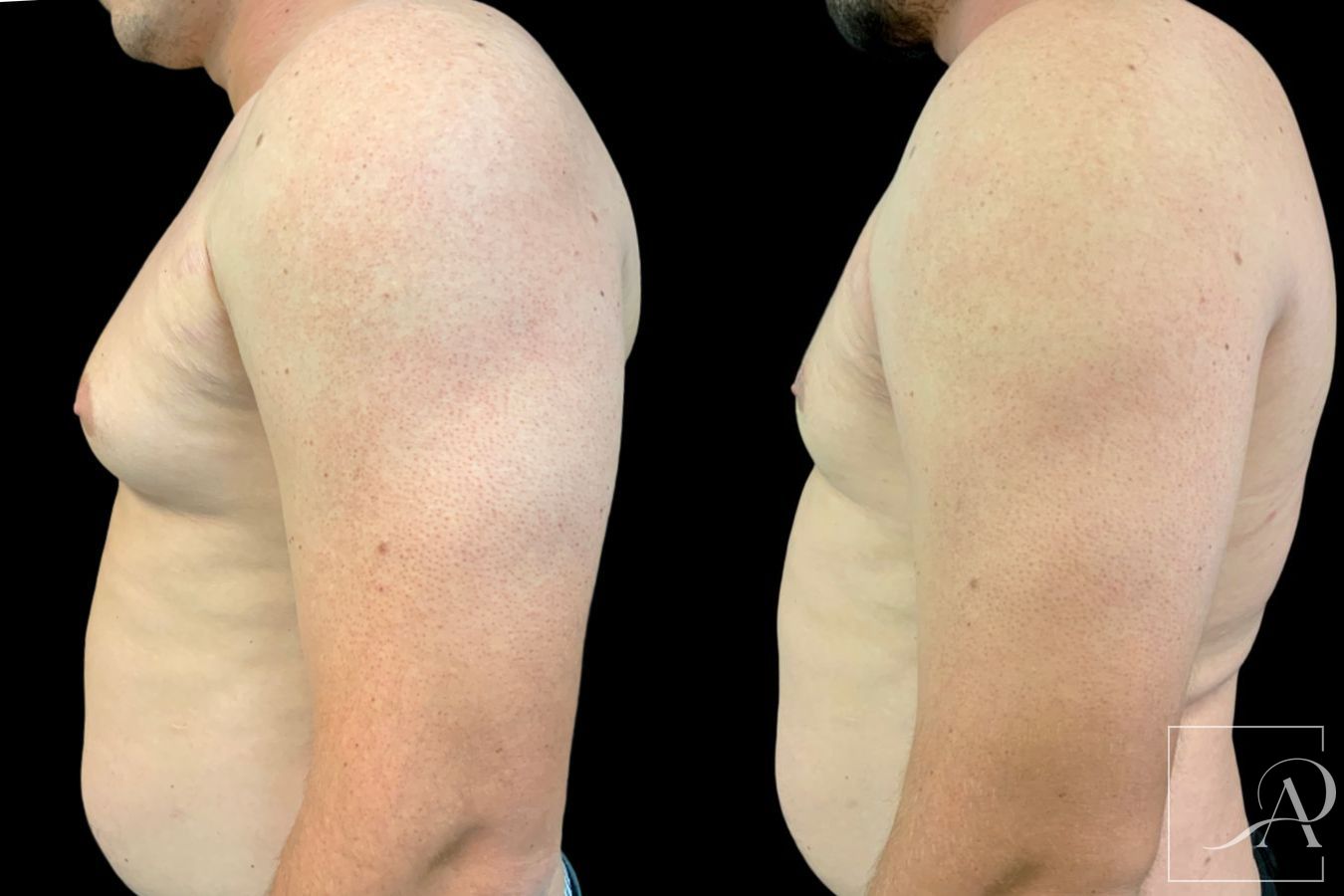 Before and after Gynecomastia case 46132 - Angle 3