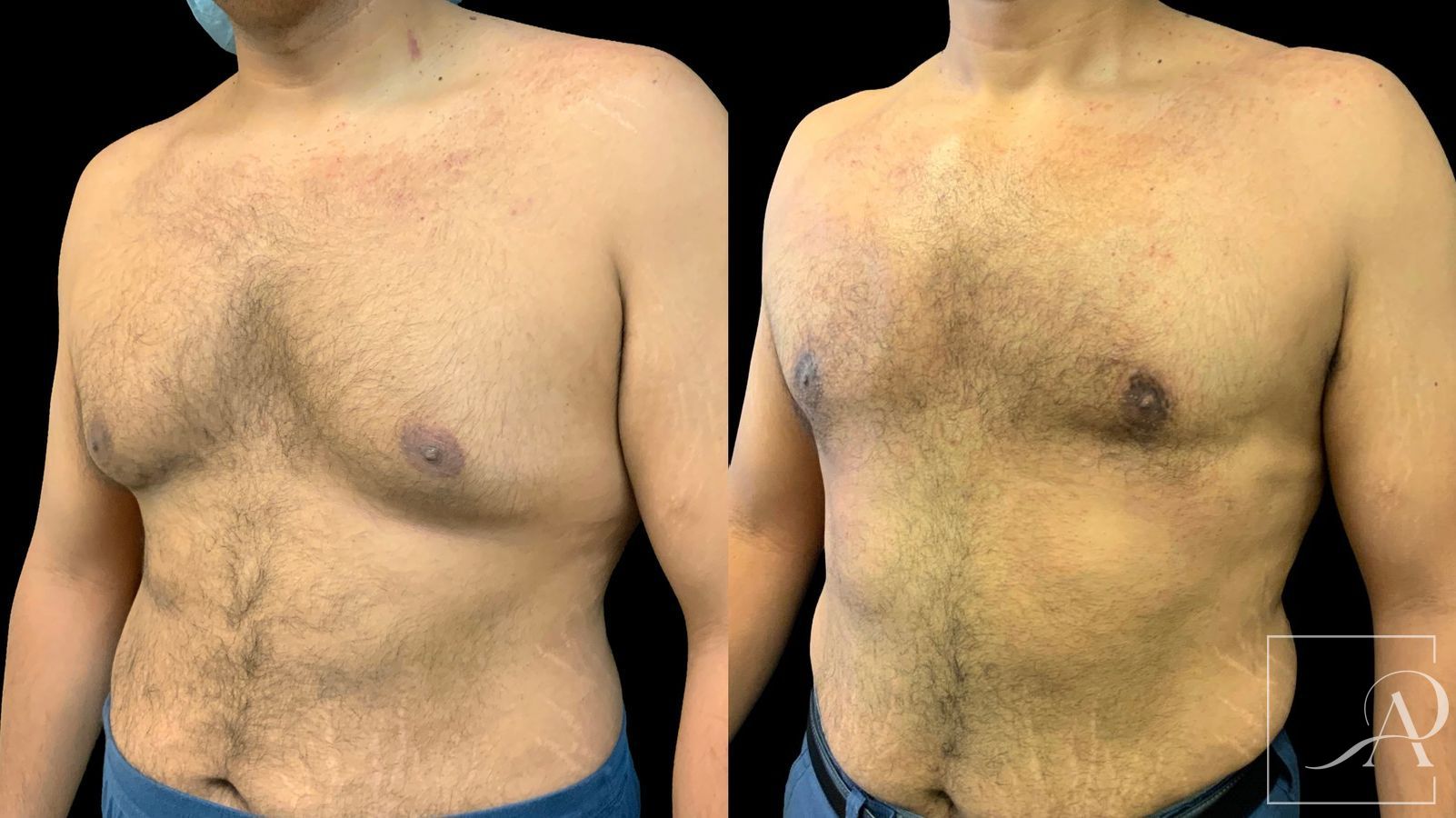 Before and after Gynecomastia case 43367 - Angle 2