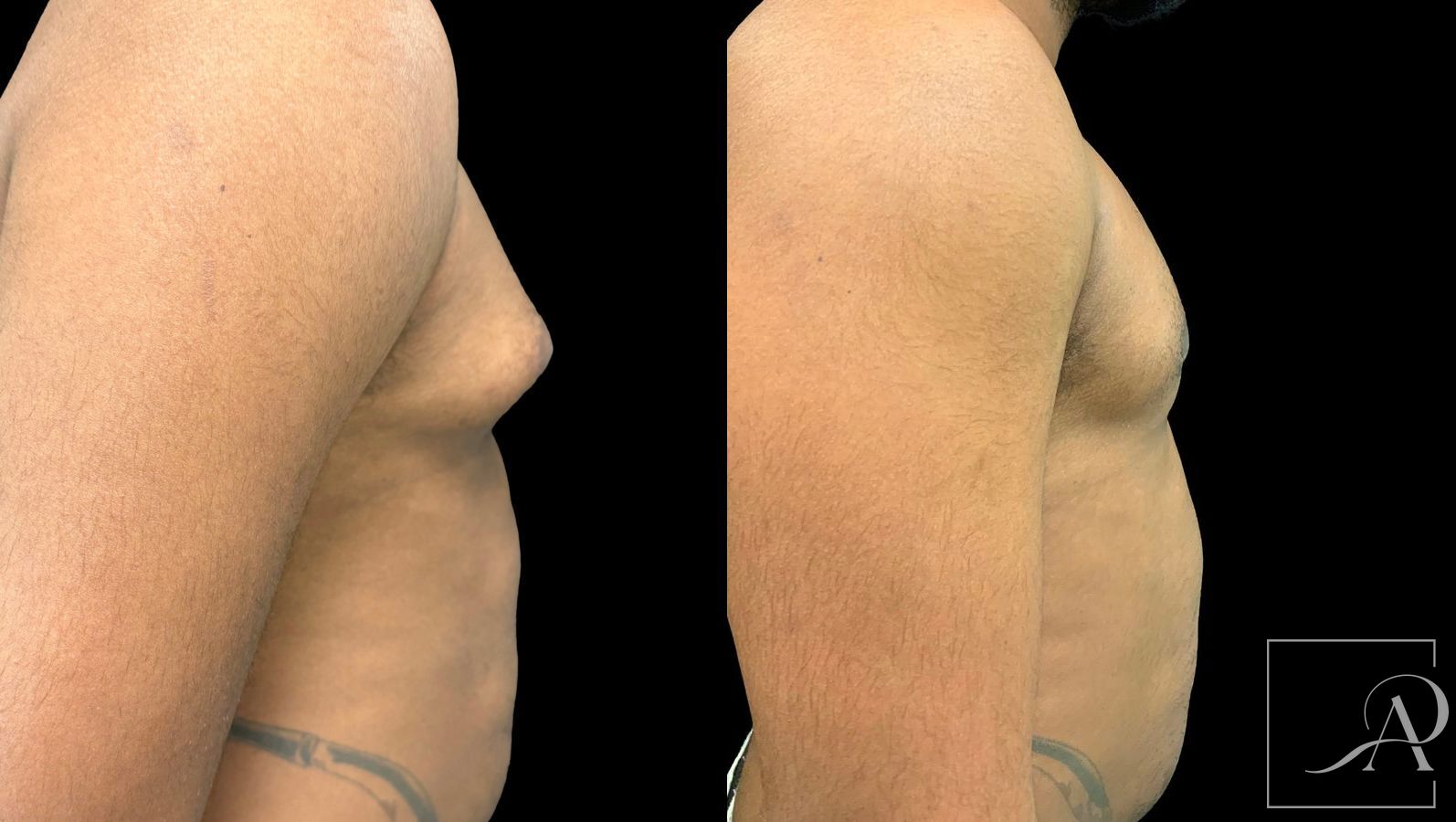 Before and after Gynecomastia case 43369 - Angle 5