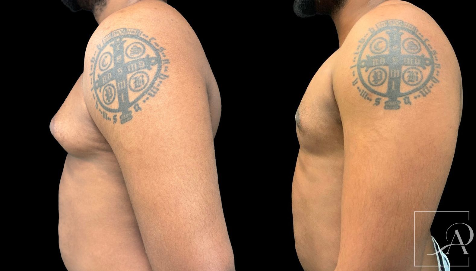 Before and after Gynecomastia case 43369