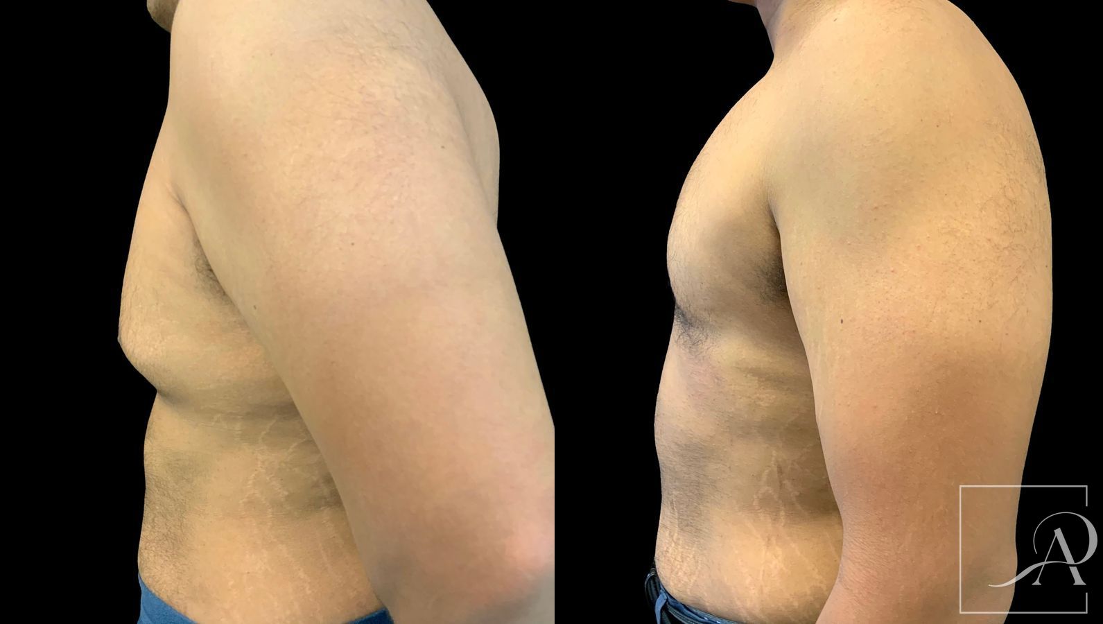 Before and after Gynecomastia case 43367