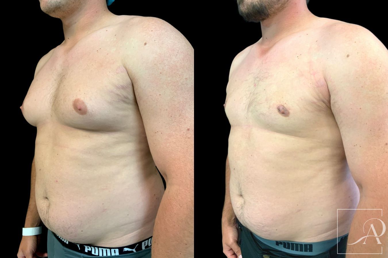 Before and after Gynecomastia case 46132 - Angle 2