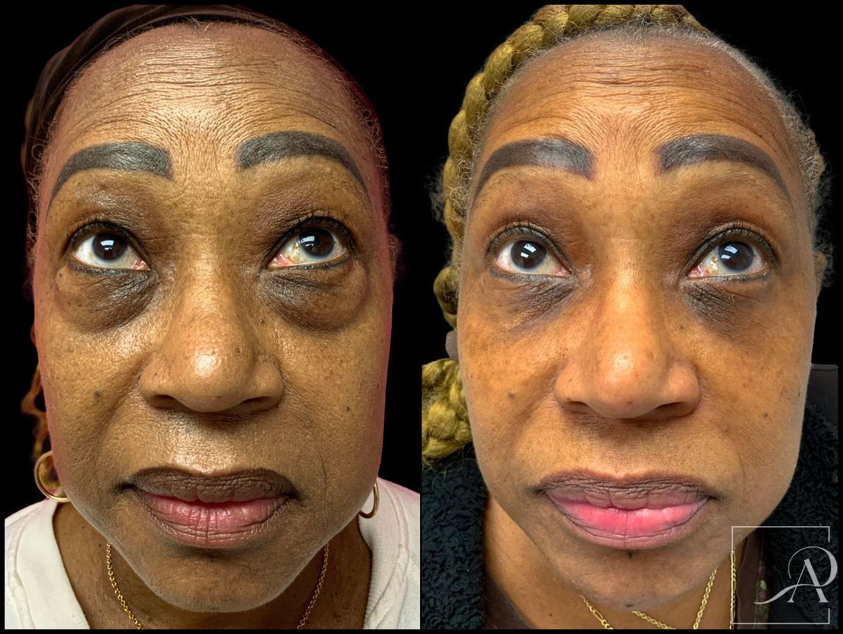 Before and after Lower Blepharoplasty case 43384 - Angle 3