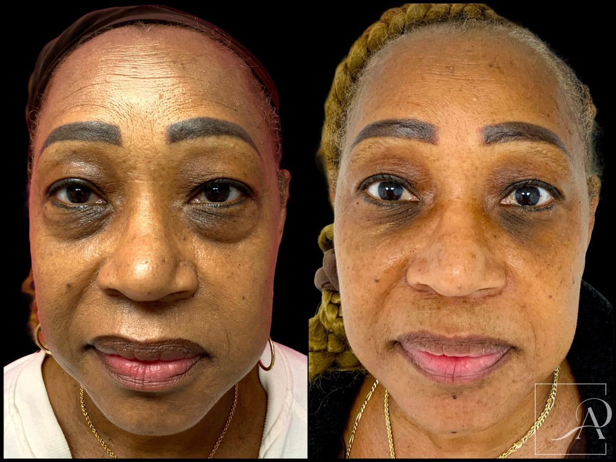 Before and after Lower Blepharoplasty case 43384 - Angle 2