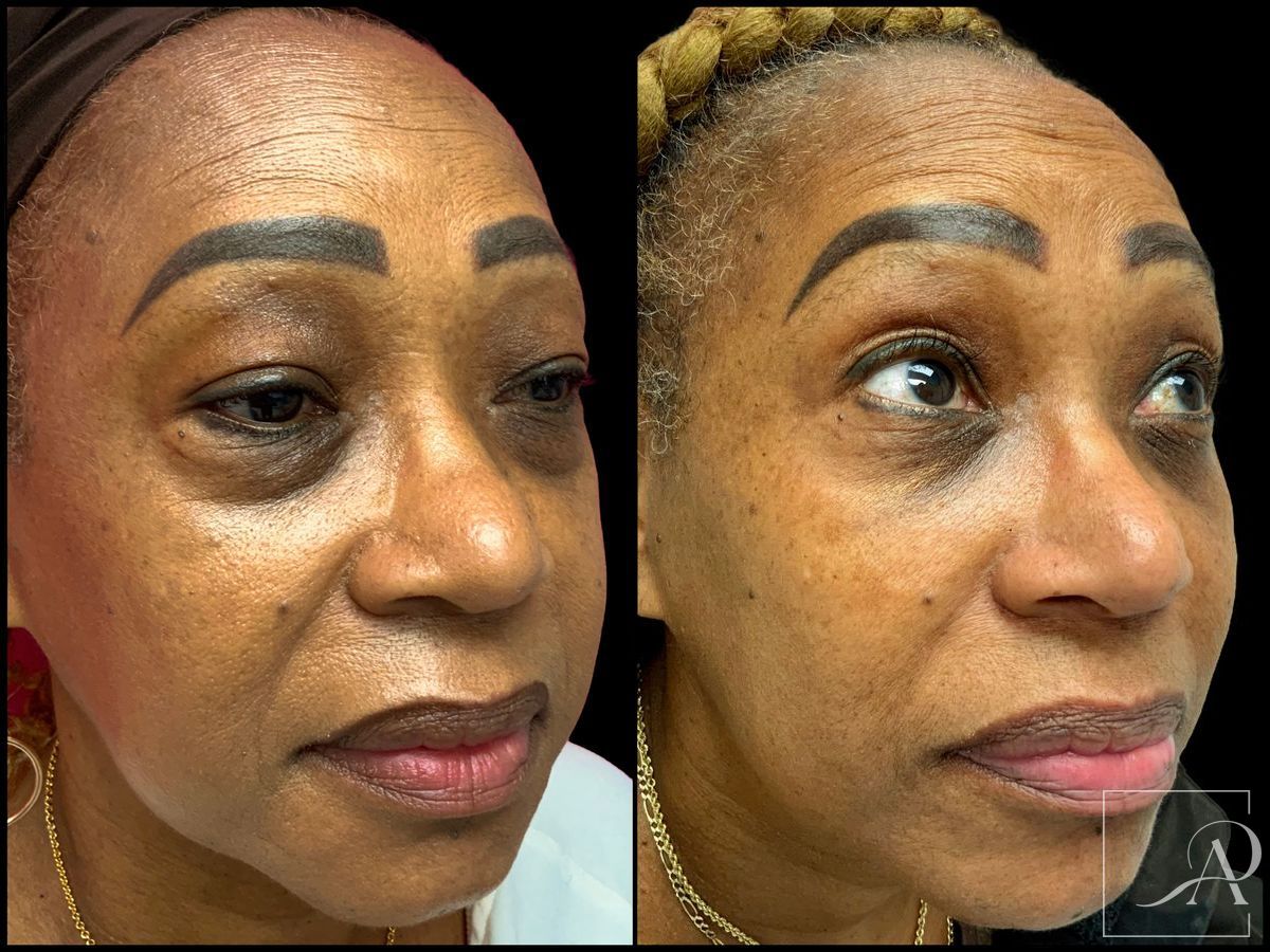 Before and after Lower Blepharoplasty case 43384 - Angle 4