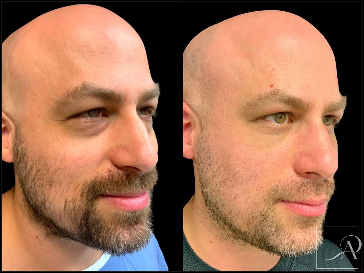 Before and after Lower Blepharoplasty case 43383 - Angle 4