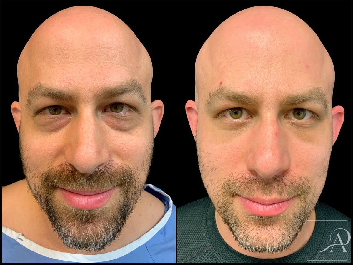 Before and after Lower Blepharoplasty case 43383 - Angle 2