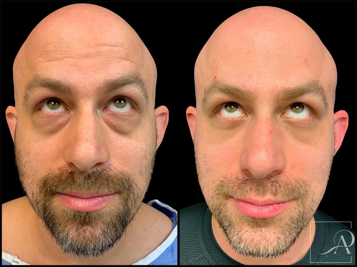 Before and after Lower Blepharoplasty case 43383 - Angle 3