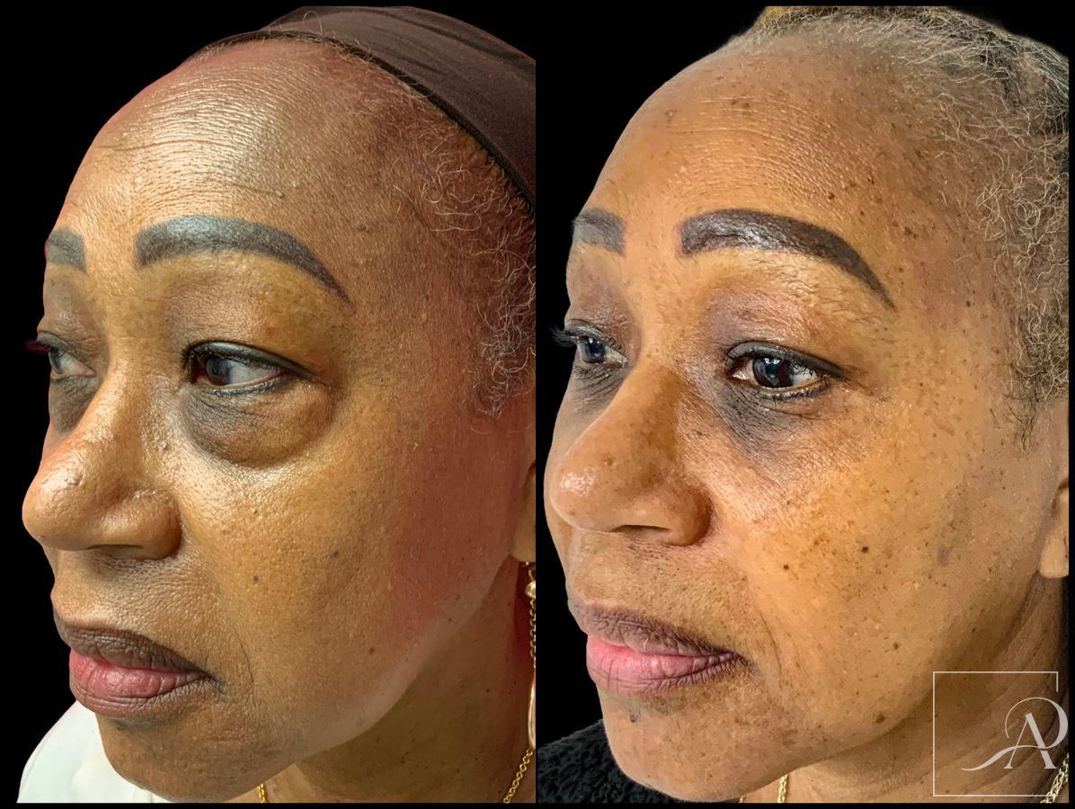 Before and after Lower Blepharoplasty case 43384