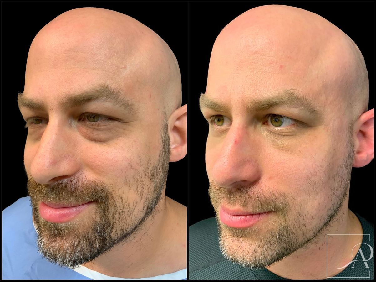 Before and after Lower Blepharoplasty case 43383
