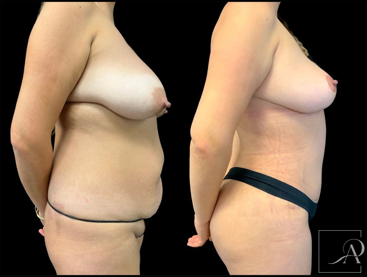 Before and after Brazilian Butt Lift case 43371 - Angle 5