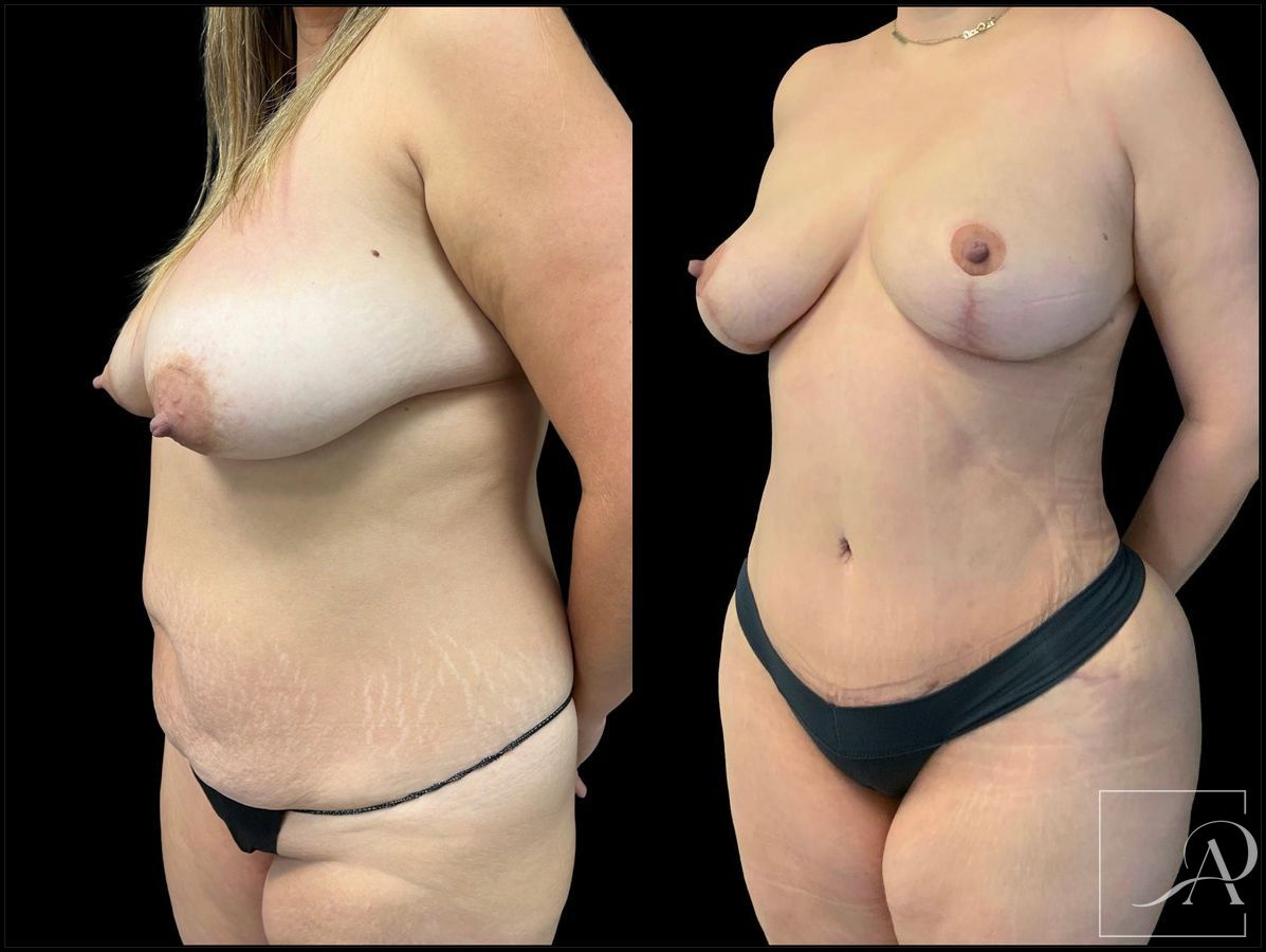 Before and after Brazilian Butt Lift case 43371 - Angle 2