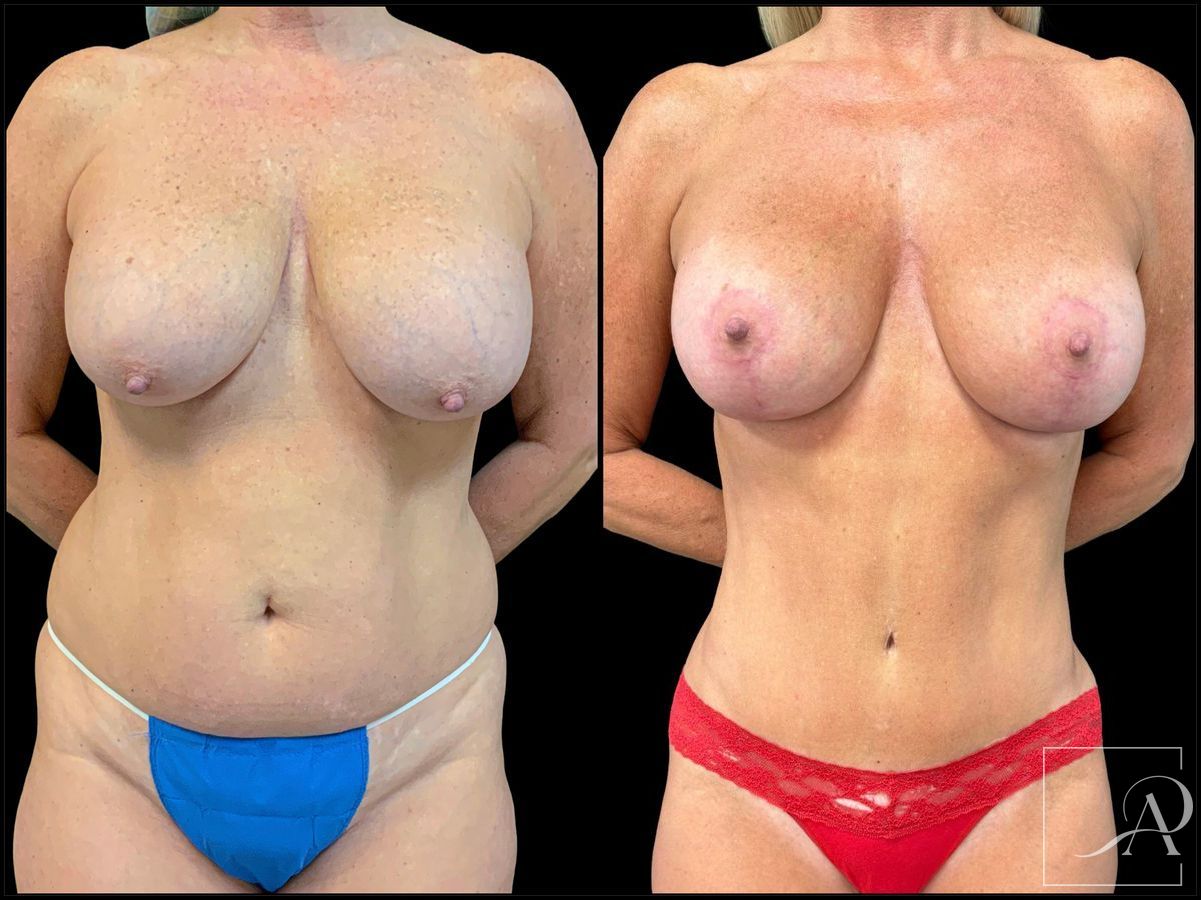Before and after Breast Augmentation with Lift case 43370 - Angle 3