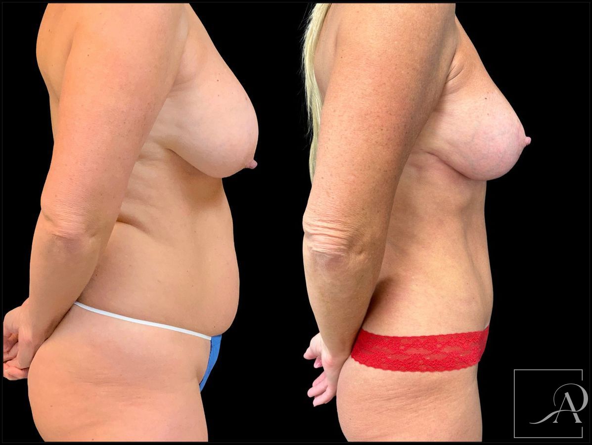 Before and after Breast Augmentation with Lift case 43370 - Angle 5