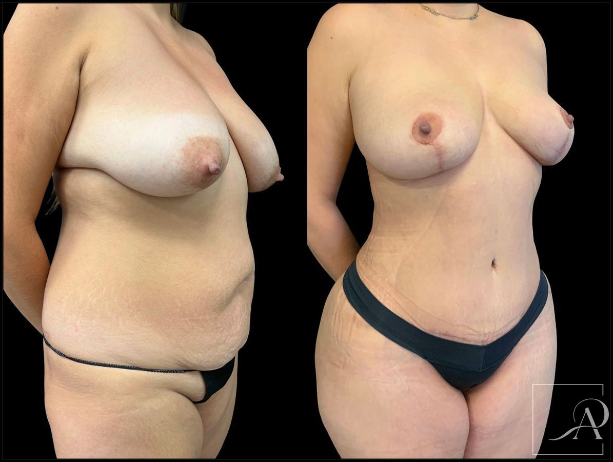 Before and after Brazilian Butt Lift case 43371 - Angle 4