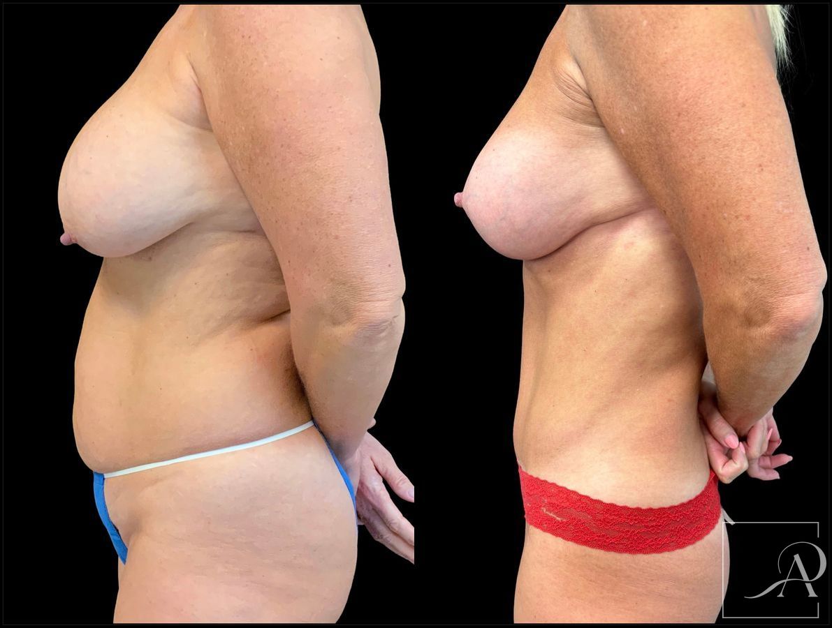 Before and after Breast Augmentation with Lift case 43370