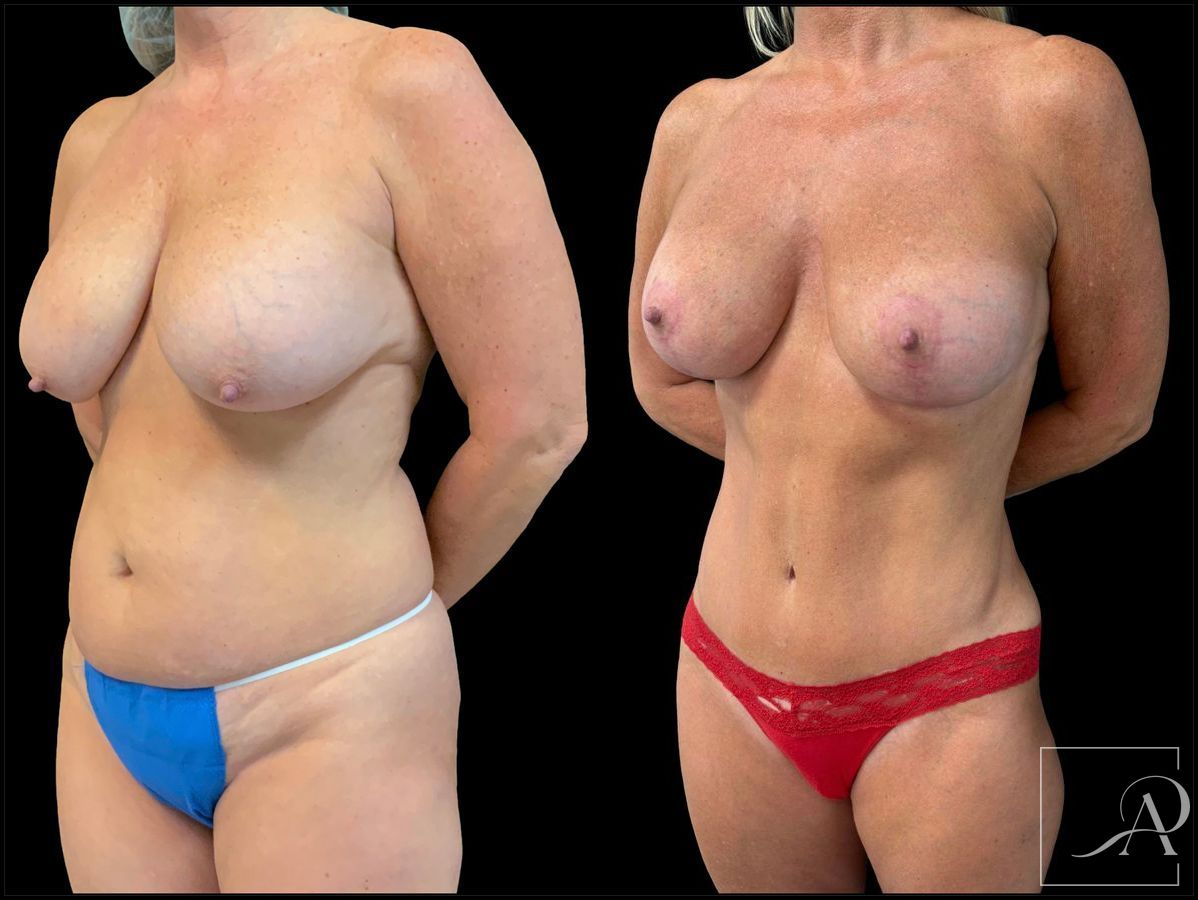 Before and after Breast Augmentation with Lift case 43370 - Angle 2