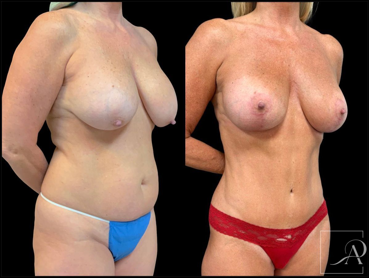 Before and after Breast Augmentation with Lift case 43370 - Angle 4