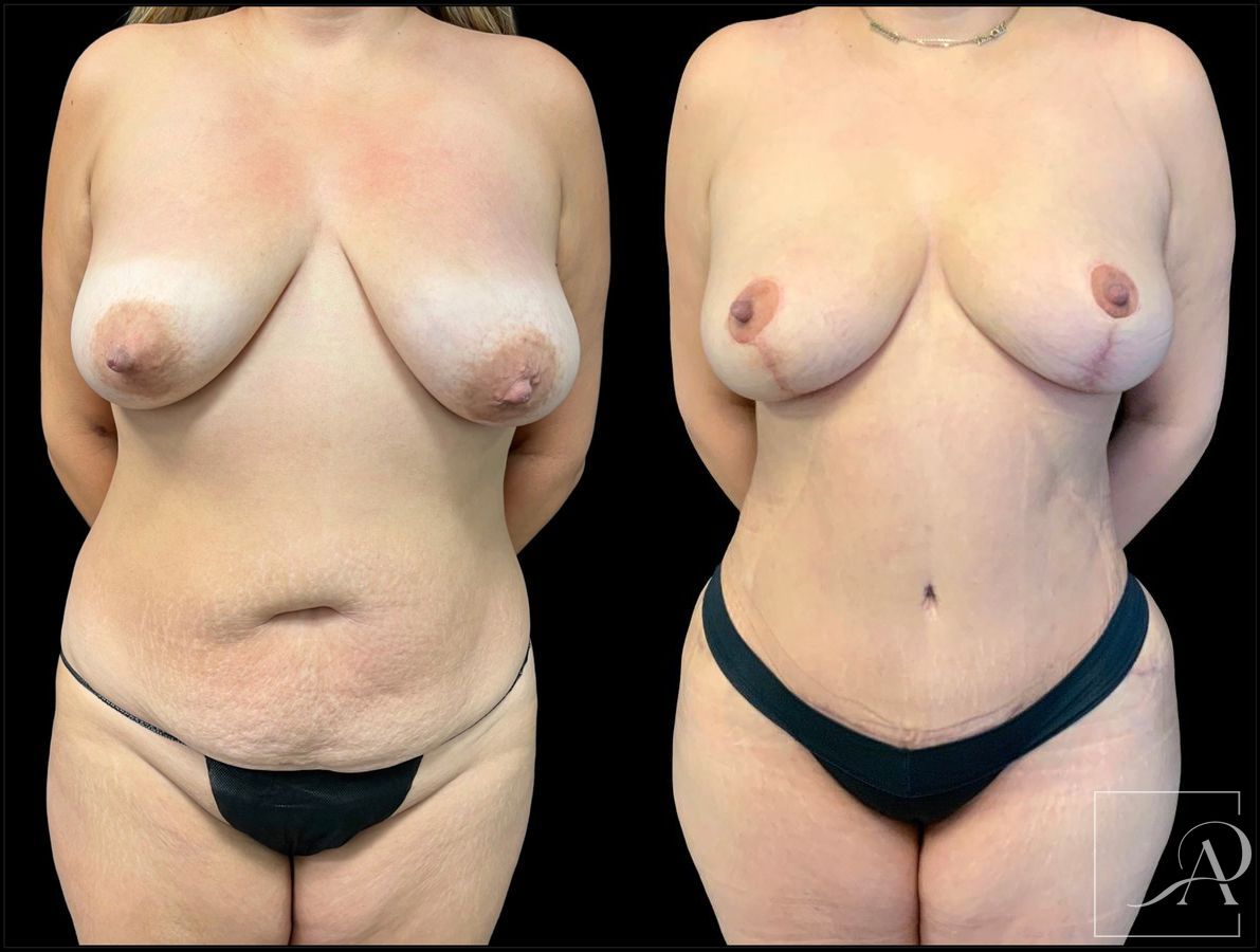 Before and after Brazilian Butt Lift case 43371 - Angle 3