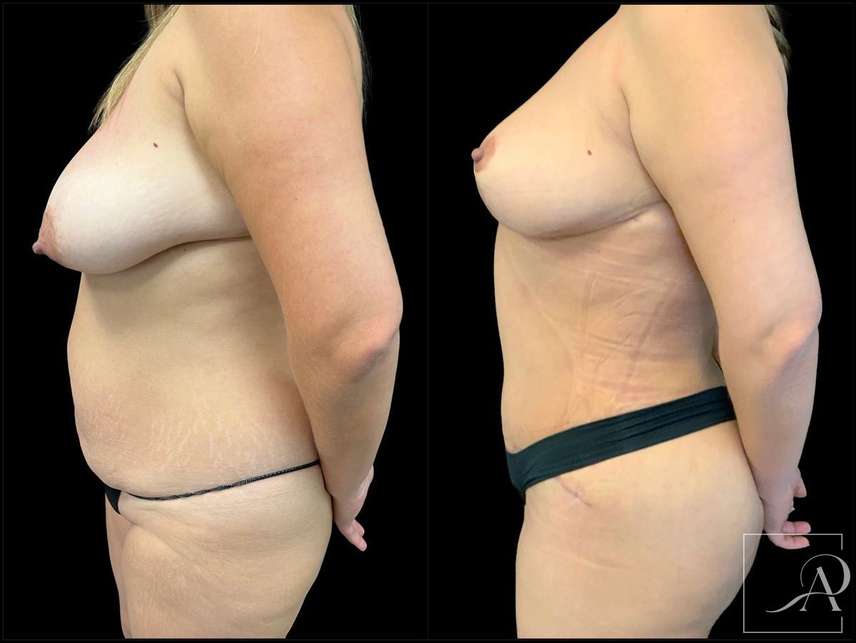 Before and after Brazilian Butt Lift case 43371
