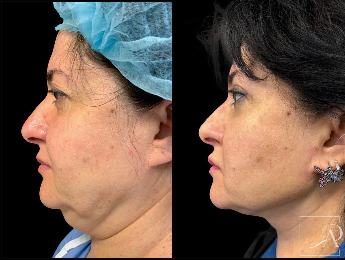 Before and after Neck Lift case 43388