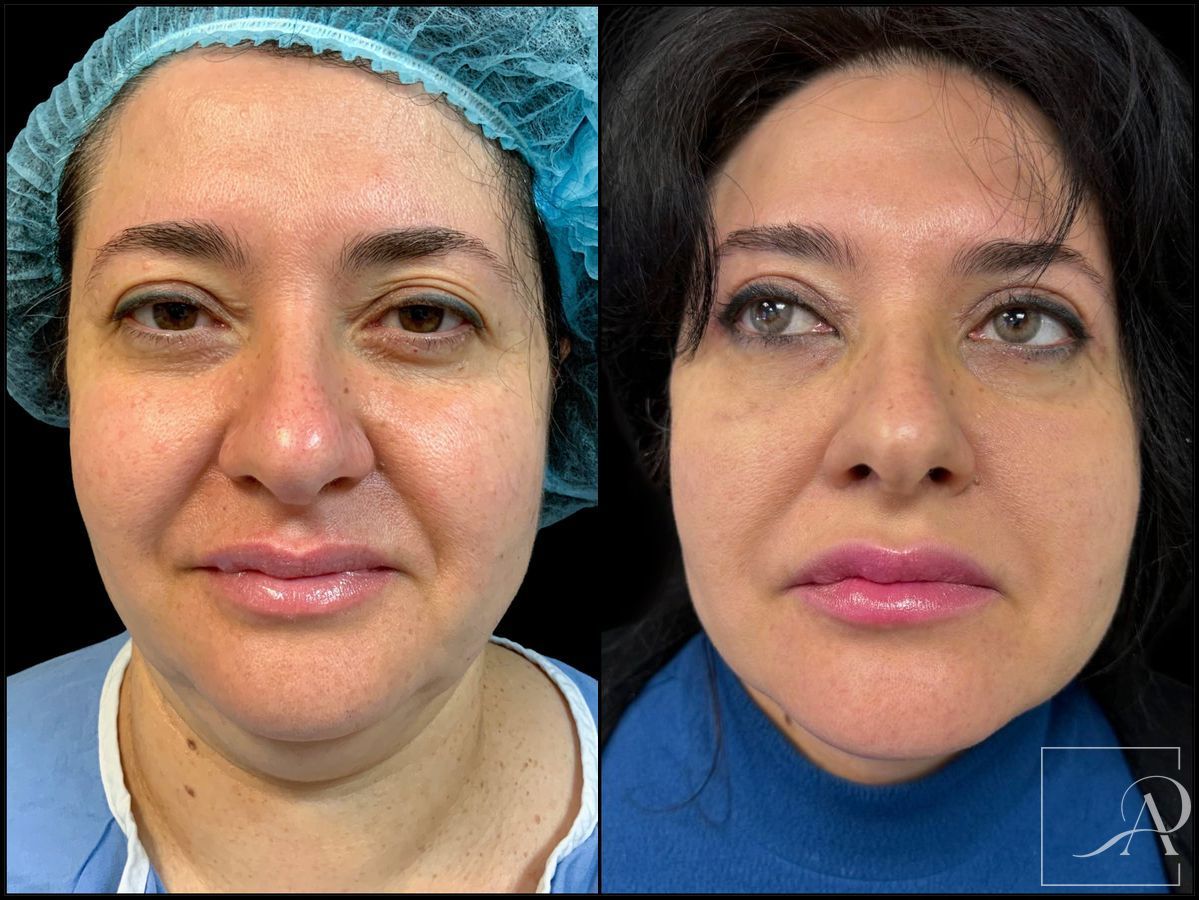 Before and after Neck Lift case 43388 - Angle 3