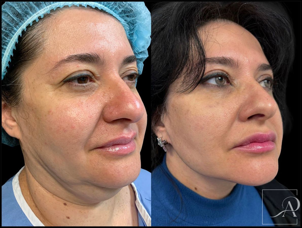 Before and after Neck Lift case 43388 - Angle 4