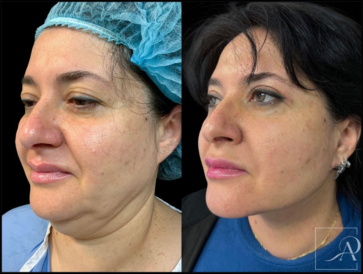 Before and after Neck Lift case 43388 - Angle 2