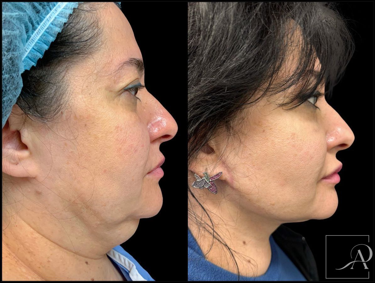 Before and after Neck Lift case 43388 - Angle 5