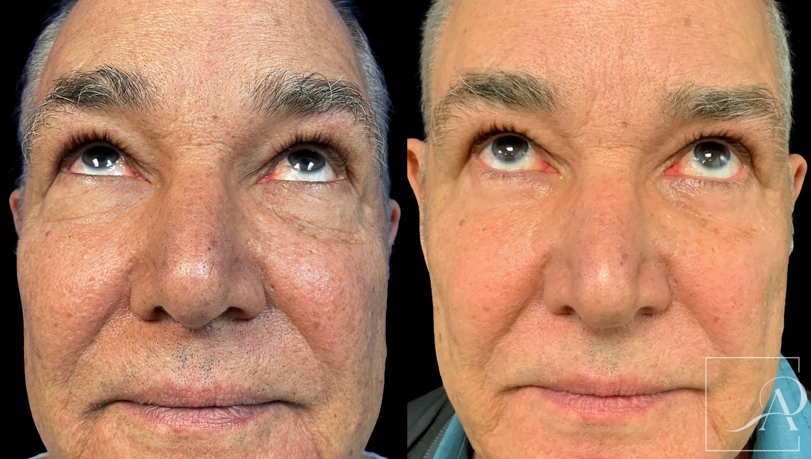 Before and after Quad Blepharoplasty case 43381 - Angle 3