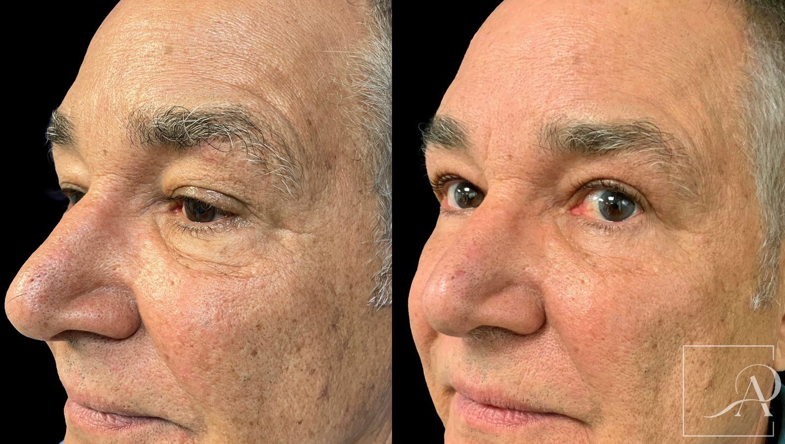 Before and after Quad Blepharoplasty case 43381 - Angle 4