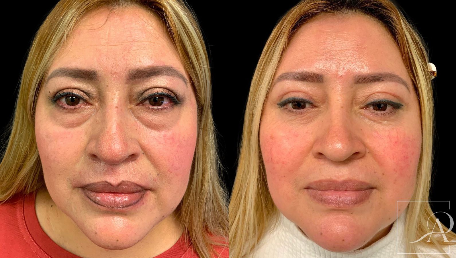 Before and after Quad Blepharoplasty case 43382