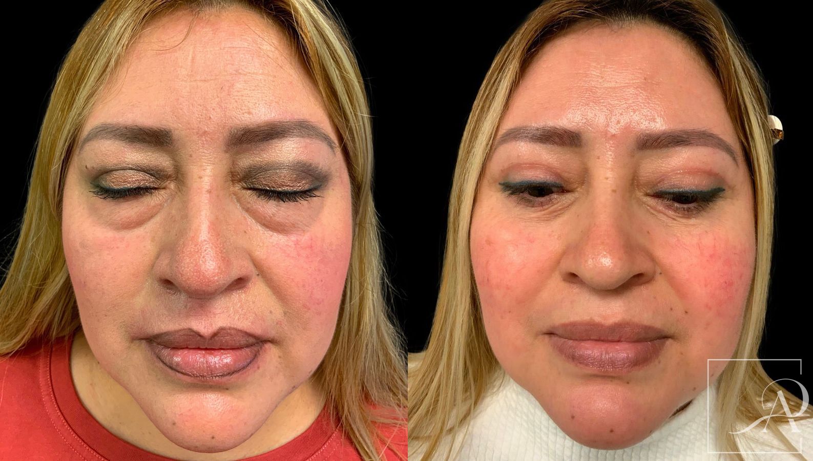 Before and after Quad Blepharoplasty case 43382 - Angle 2