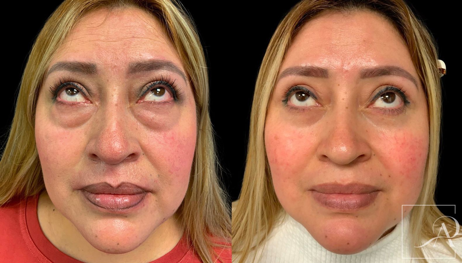 Before and after Quad Blepharoplasty case 43382 - Angle 3