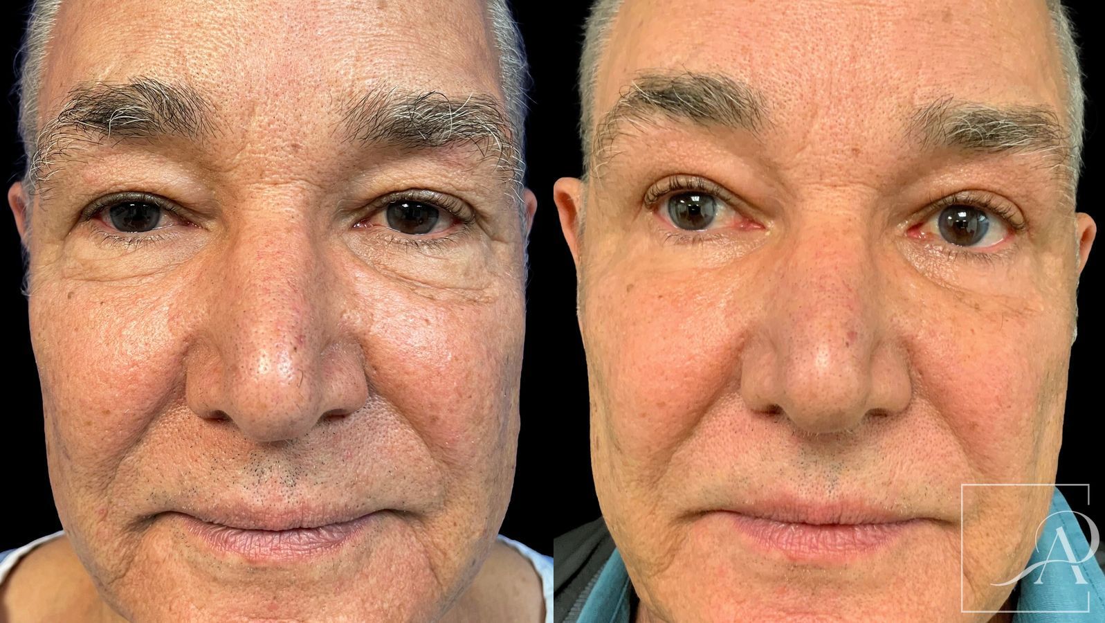Before and after Quad Blepharoplasty case 43381 - Angle 2
