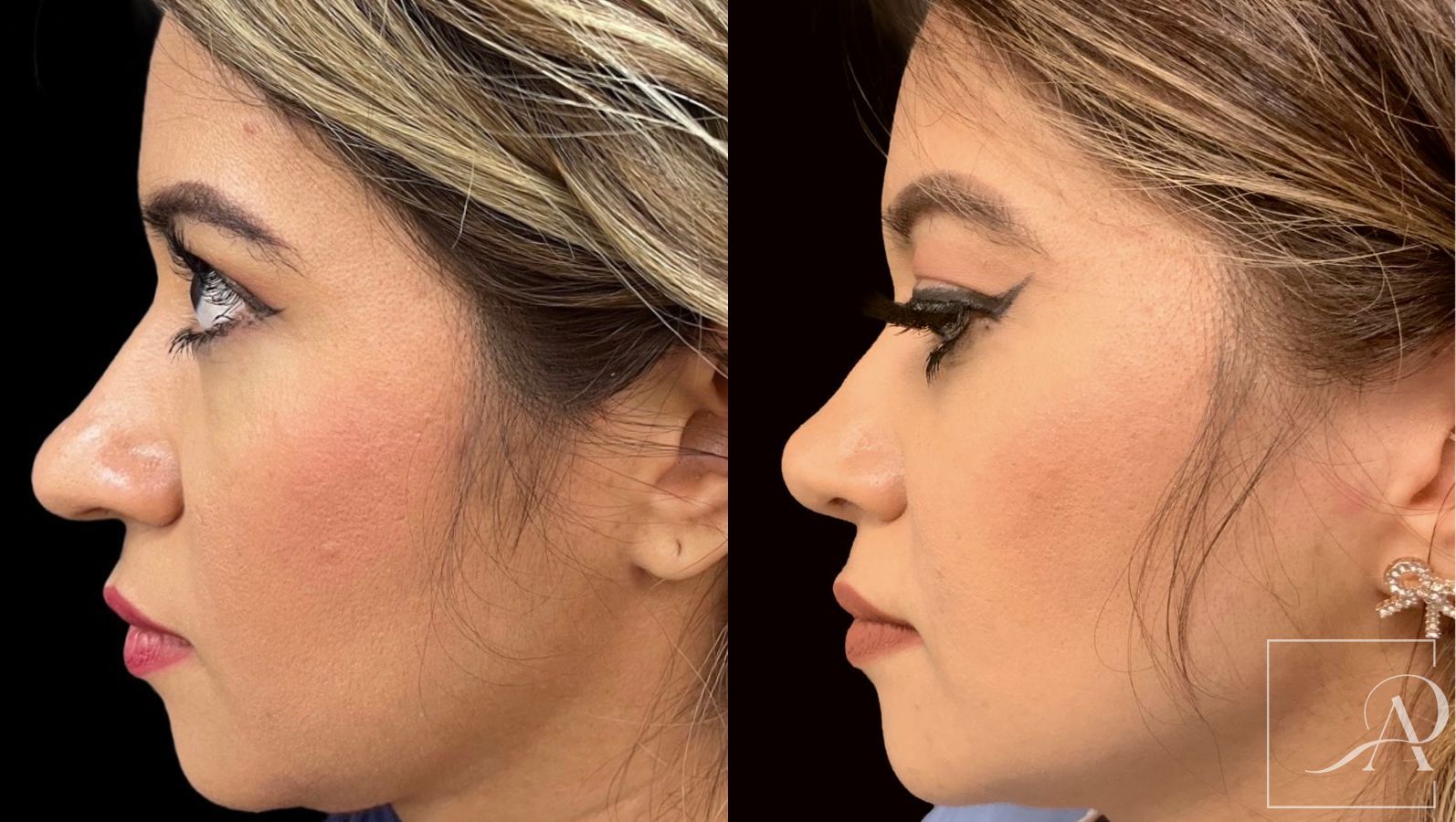 Before and after Rhinoplasty case 43389