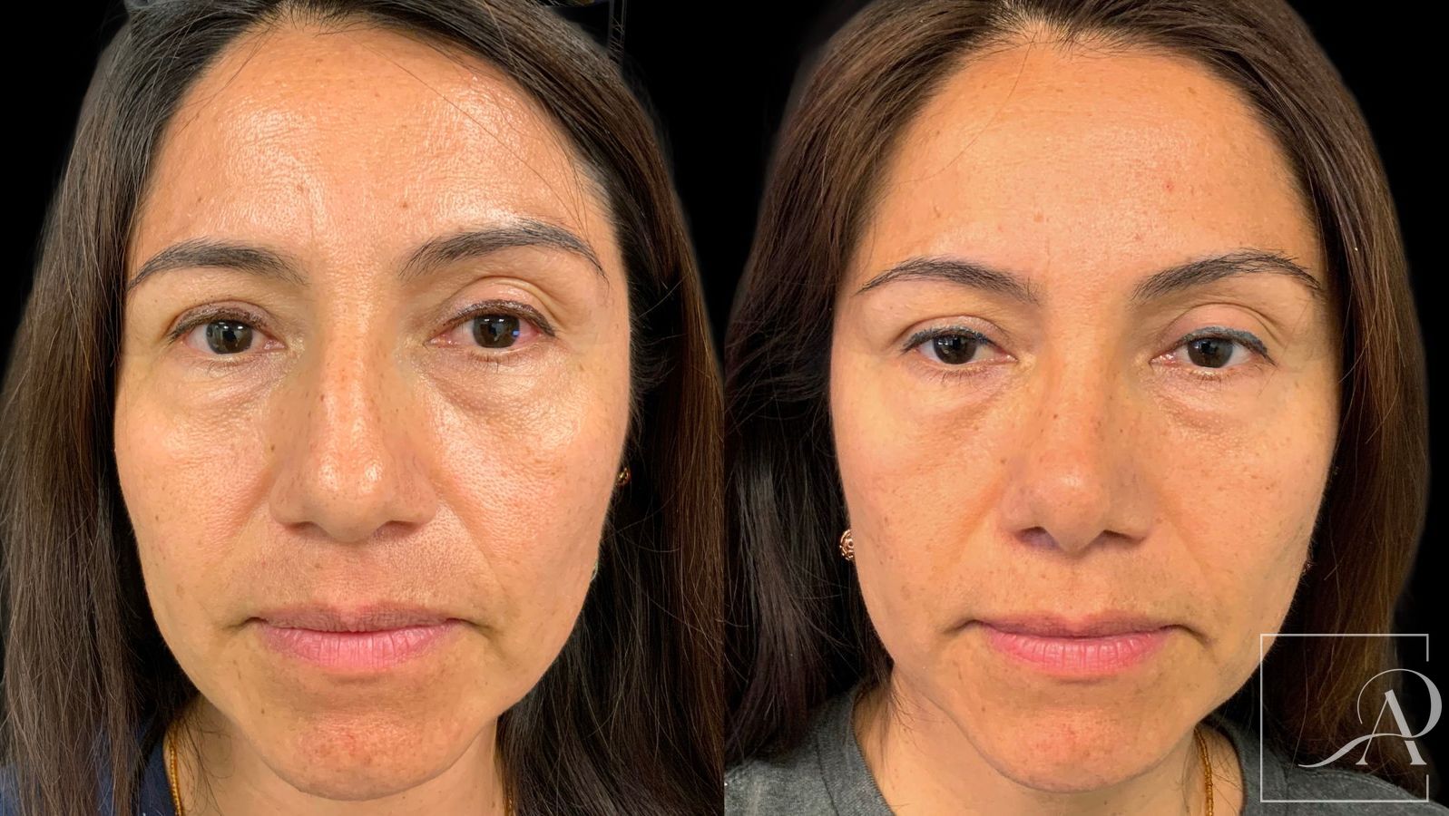 Before and after Rhinoplasty case 43390 - Angle 3