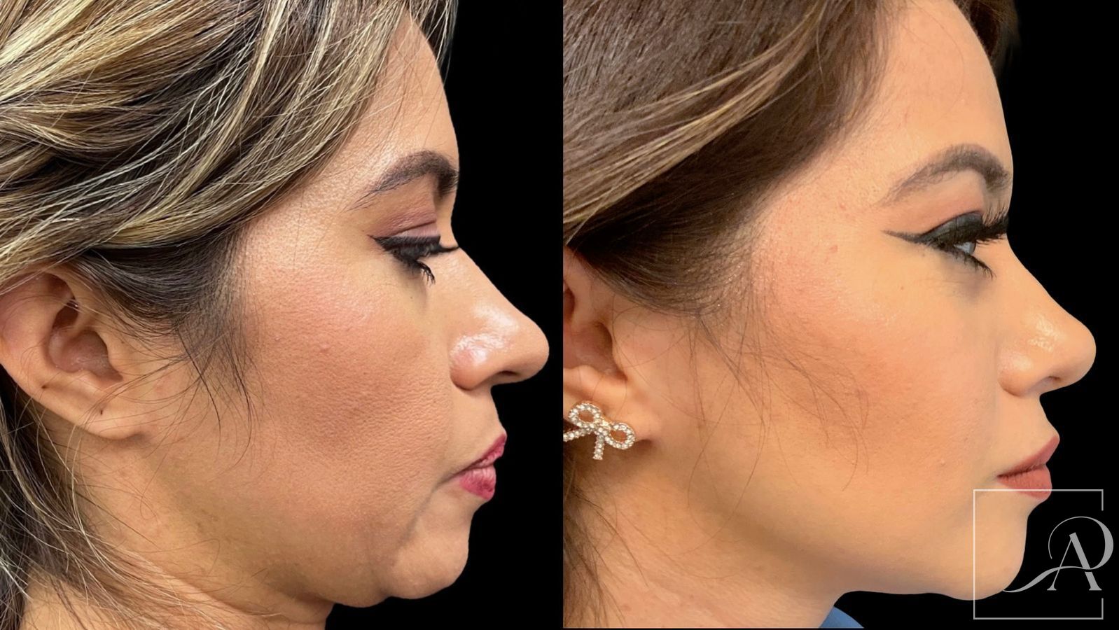 Before and after Rhinoplasty case 43389 - Angle 5