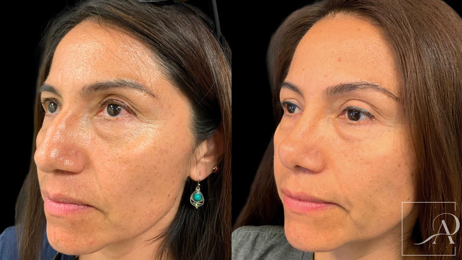 Before and after Rhinoplasty case 43390 - Angle 2