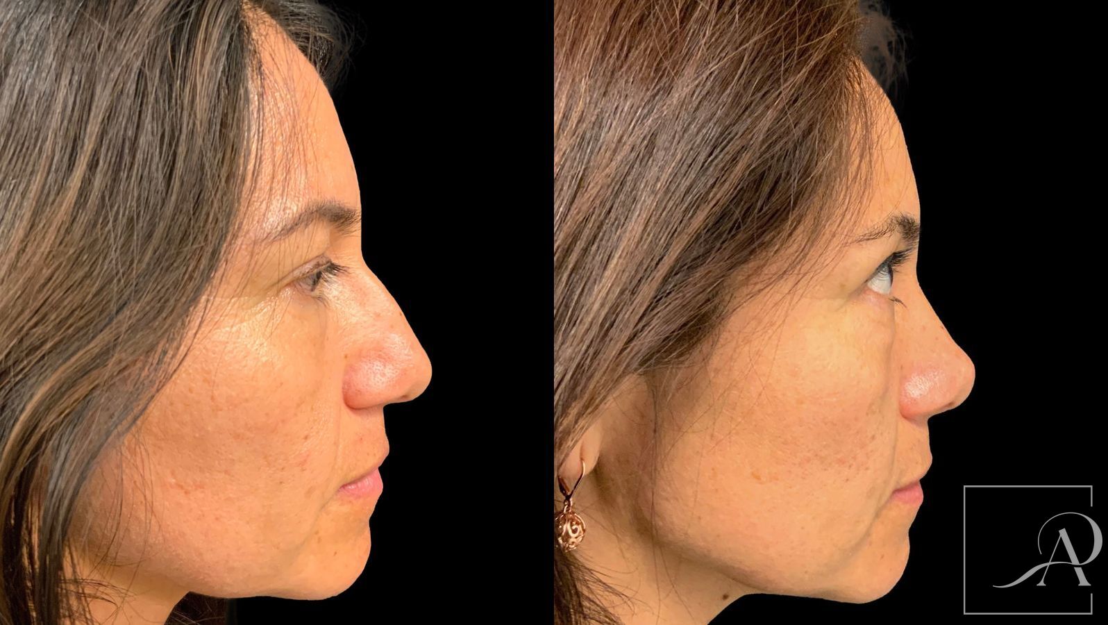 Before and after Rhinoplasty case 43390 - Angle 5