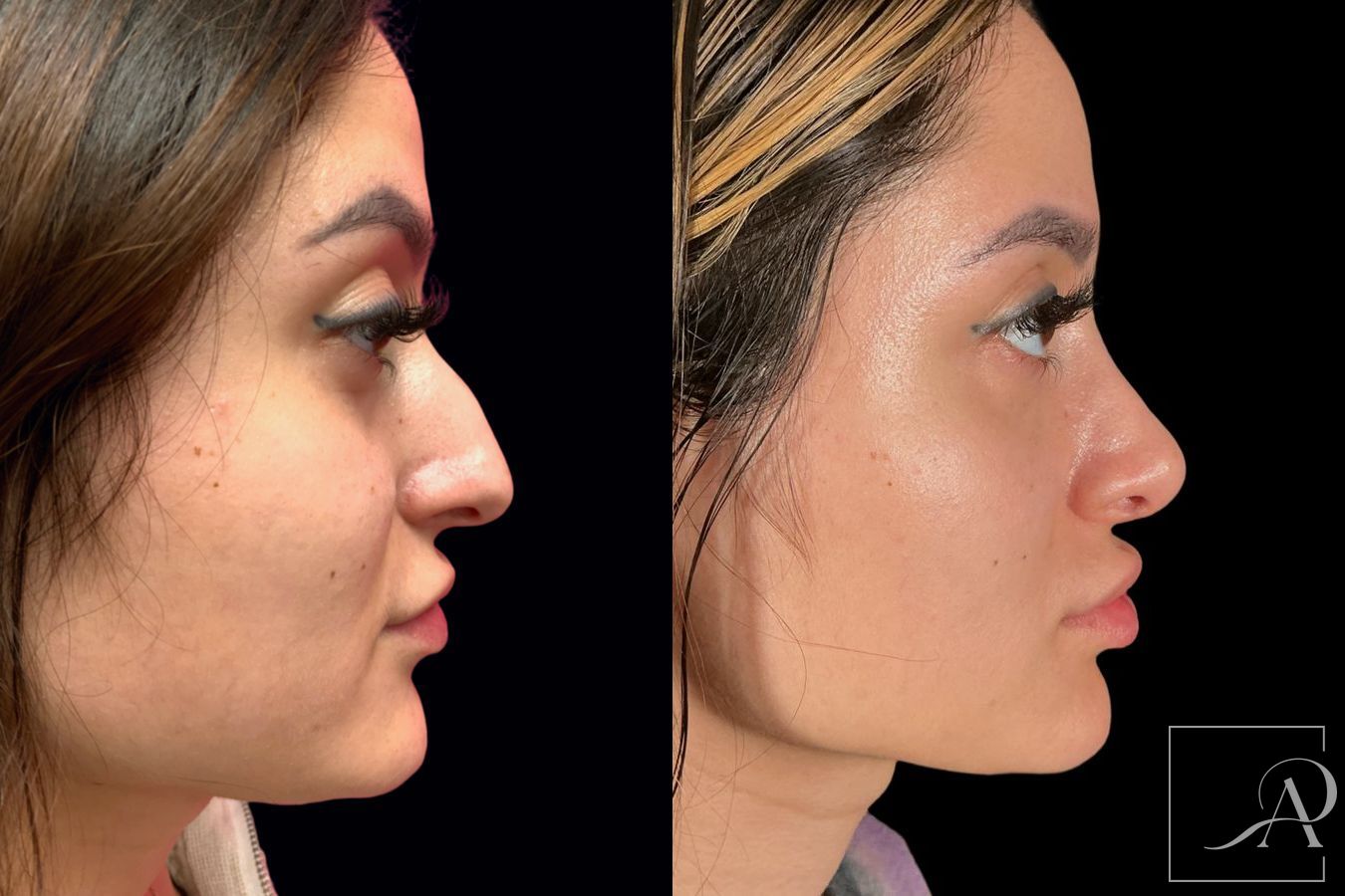 Before and after Rhinoplasty case 46338 - Angle 5