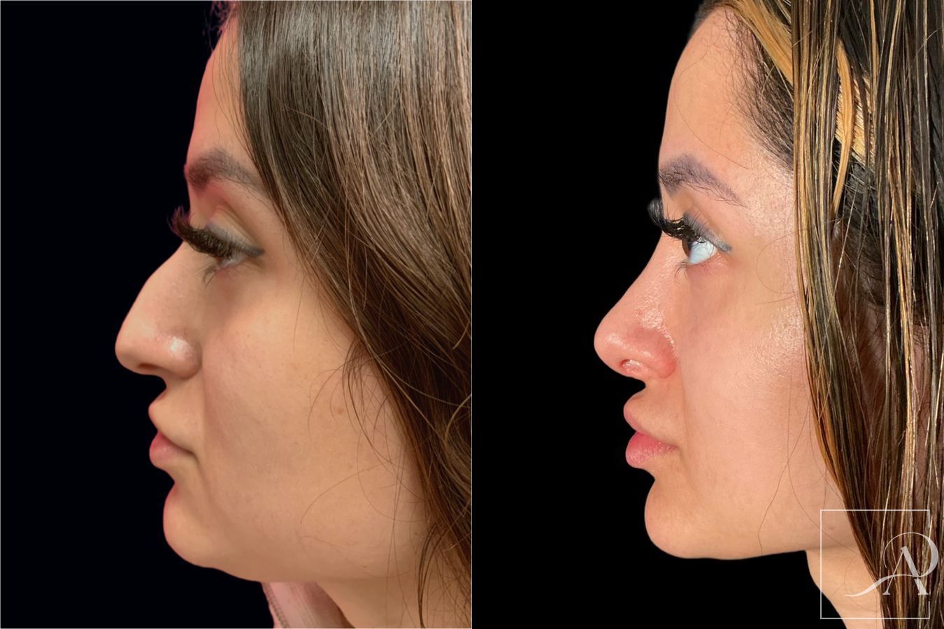 Before and after Rhinoplasty case 46338 - Angle 3