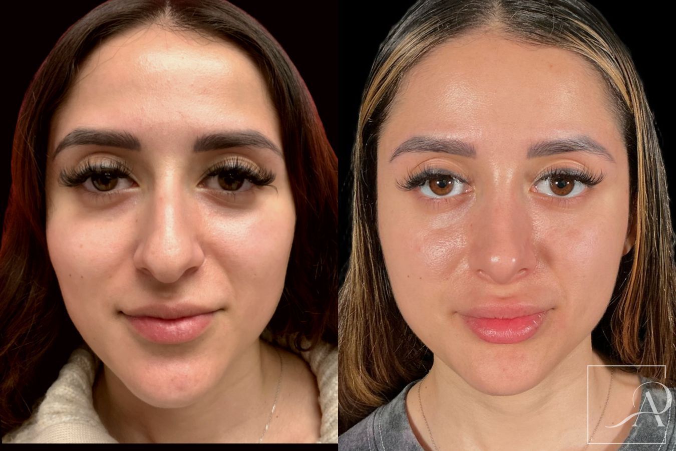 Before and after Rhinoplasty case 46338