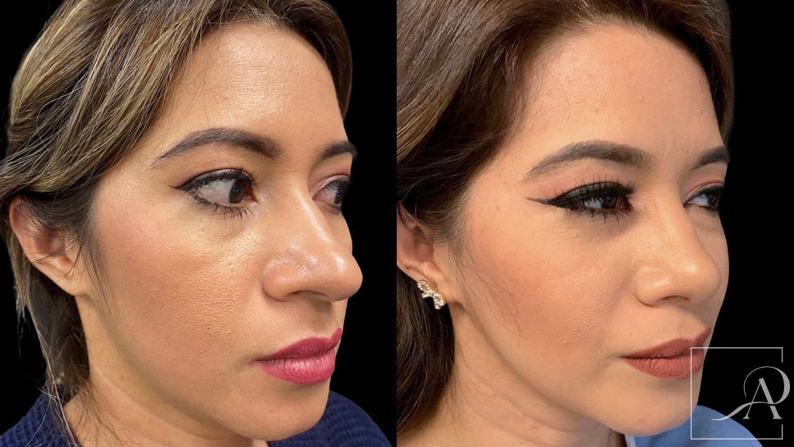 Before and after Rhinoplasty case 43389 - Angle 4