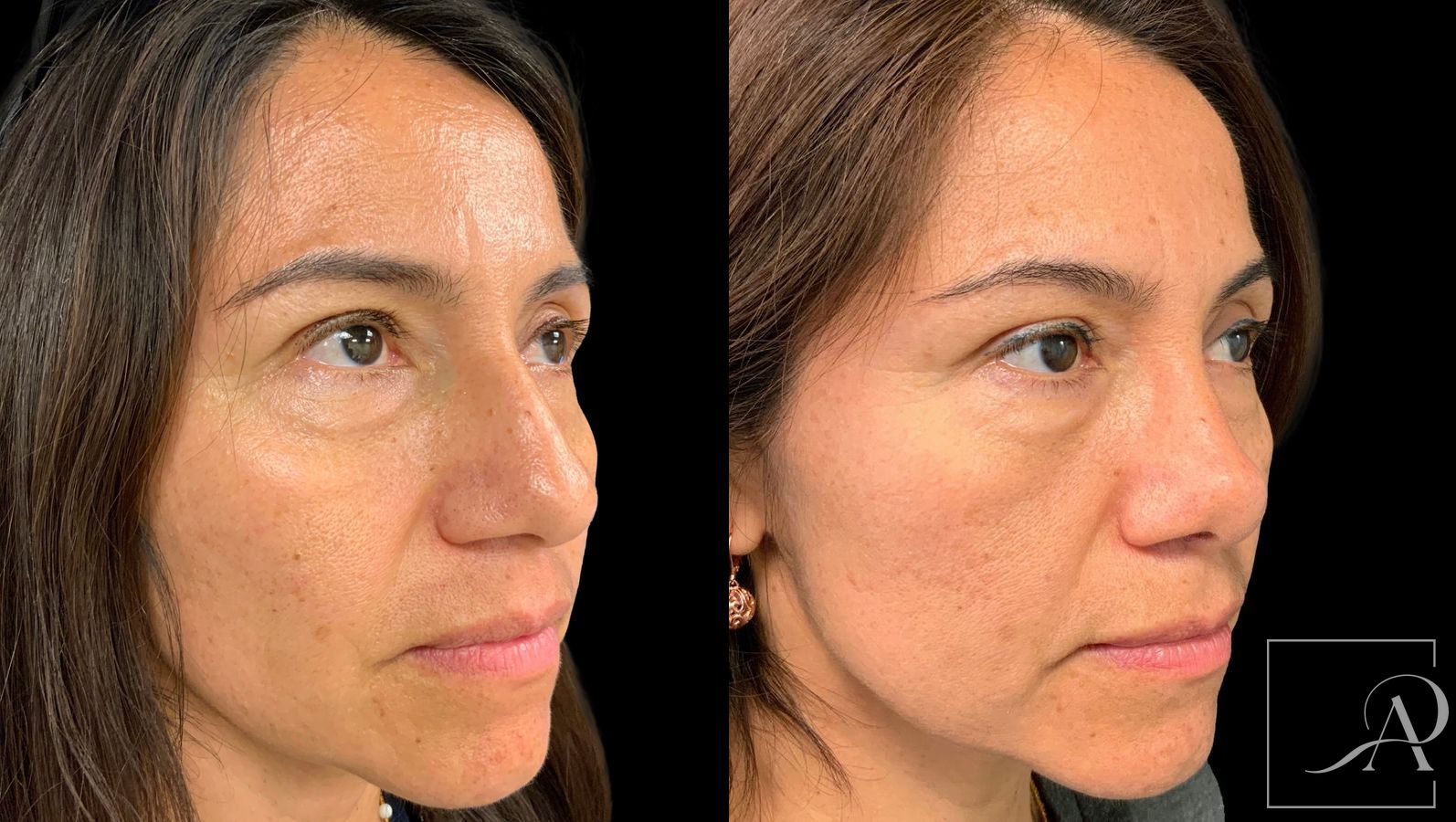 Before and after Rhinoplasty case 43390 - Angle 4
