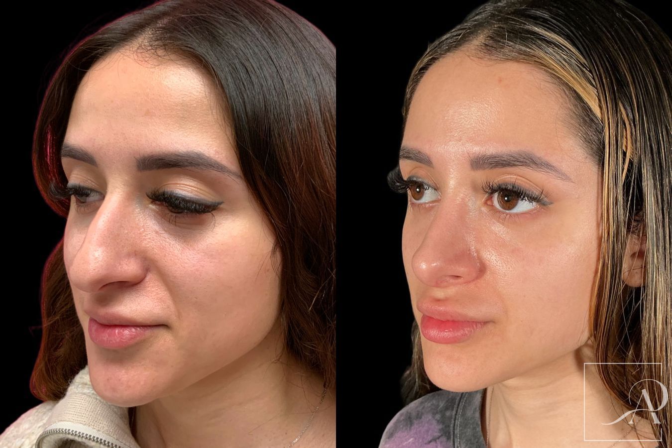 Before and after Rhinoplasty case 46338 - Angle 2