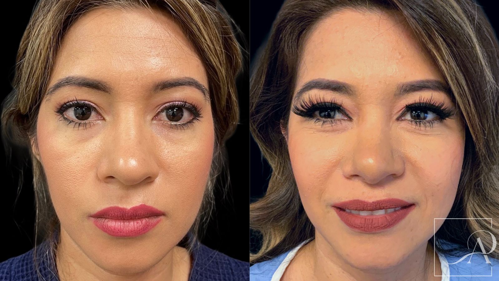 Before and after Rhinoplasty case 43389 - Angle 3